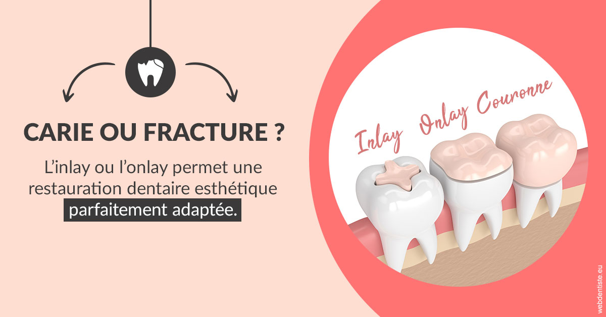 https://selarl-dr-valette-jerome.chirurgiens-dentistes.fr/T2 2023 - Carie ou fracture 2