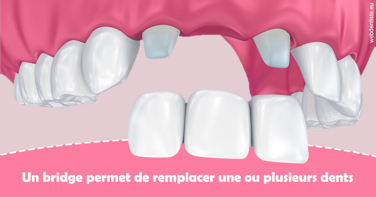 https://selarl-dr-valette-jerome.chirurgiens-dentistes.fr/Bridge remplacer dents 2