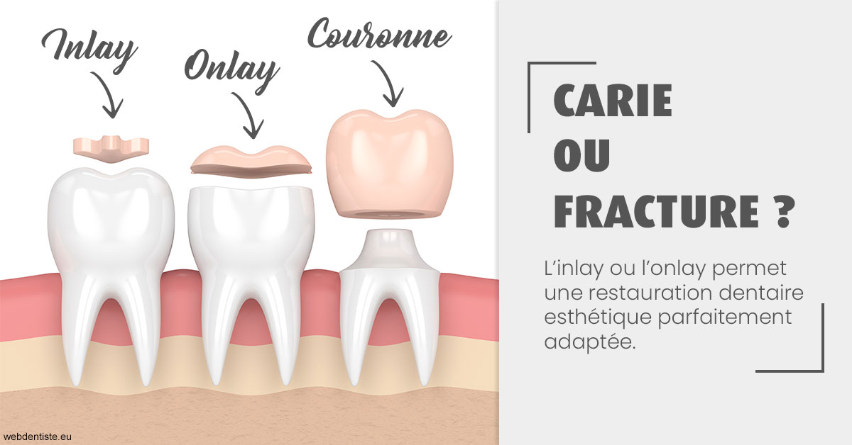 https://selarl-dr-valette-jerome.chirurgiens-dentistes.fr/T2 2023 - Carie ou fracture 1