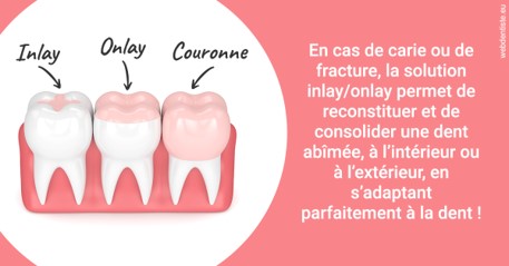 https://selarl-dr-valette-jerome.chirurgiens-dentistes.fr/L'INLAY ou l'ONLAY 2
