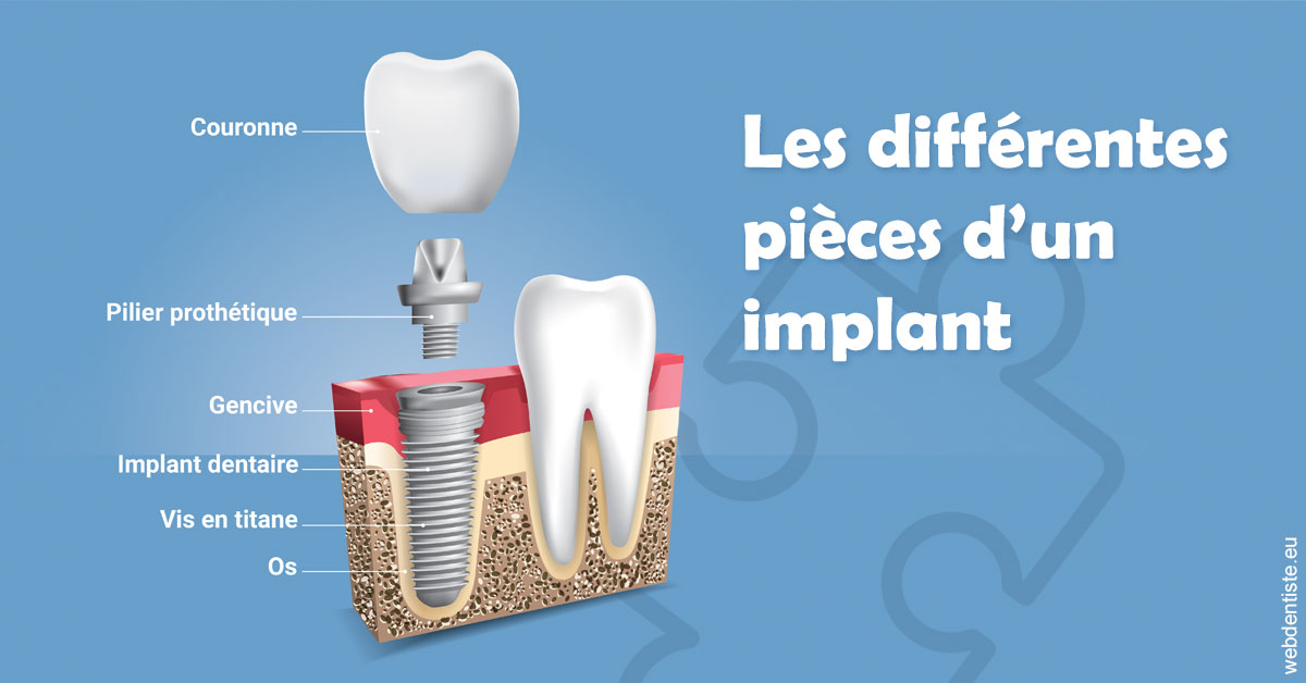https://selarl-dr-valette-jerome.chirurgiens-dentistes.fr/Les différentes pièces d’un implant 1